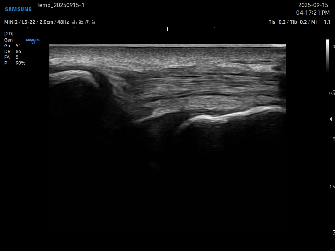 20대 여성 슬개근건염